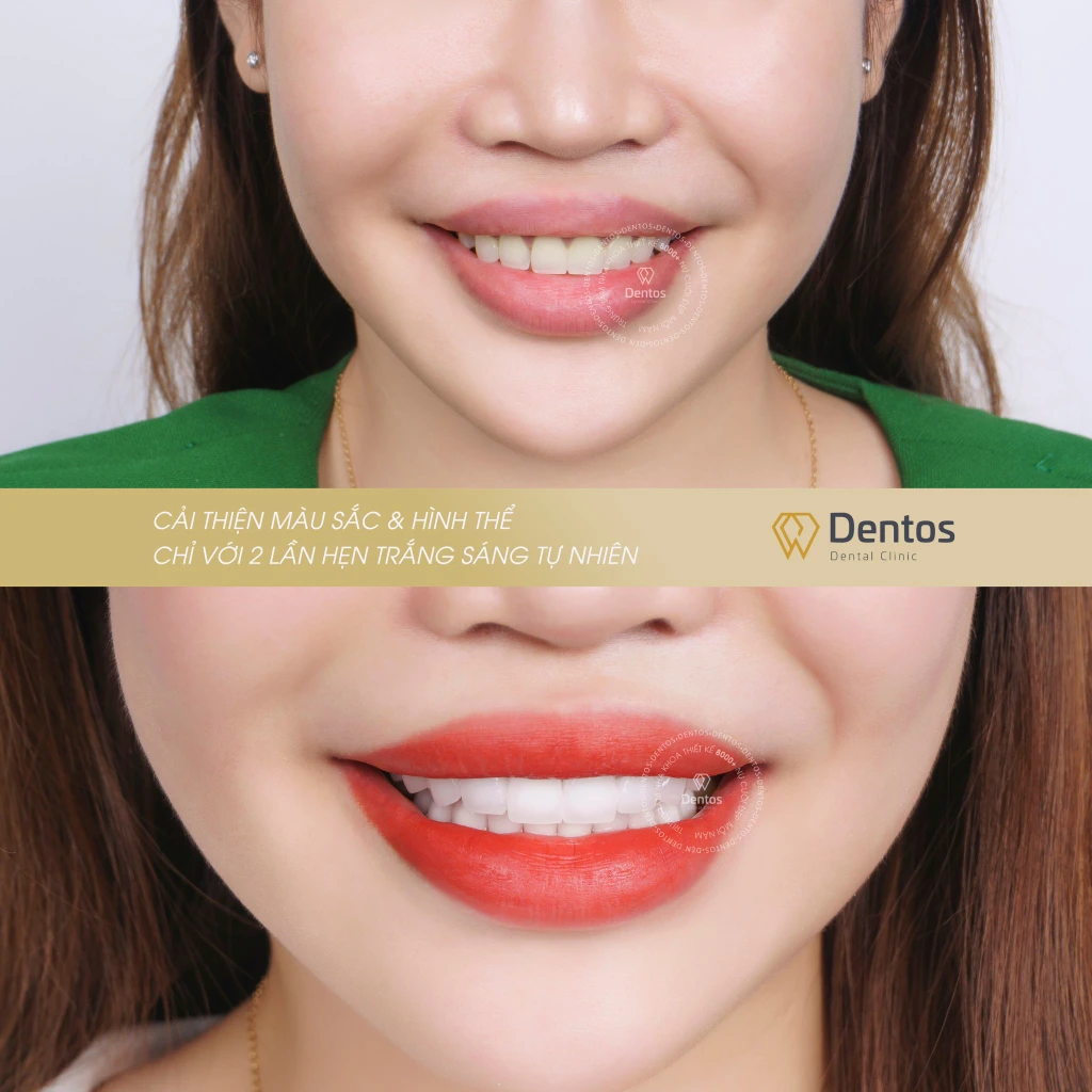 Thay thế răng sứ khắc phục tình trạng răng cũ ố vàng